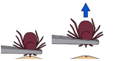 Removing a tick.